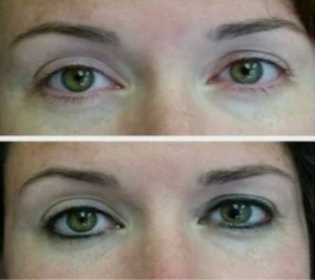 Permanent Eye Liner